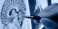 المؤتمر السادس عشر للاتحاد العربي لطب الأعصاب في نهاية ايلول الحالي
