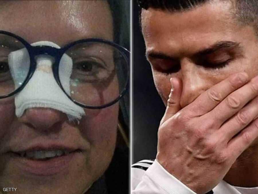 بعد أن كسر أنفها.. رونالدو يجبر خاطر "الضحية"