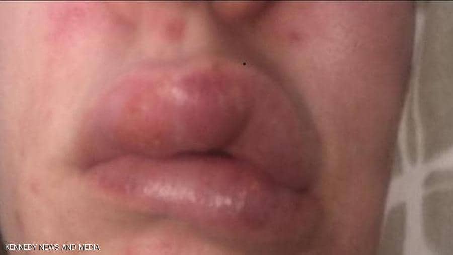 عملية نفخ شفاه تشوه وجه فتاة