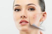 أطعمة تسبب ظهور البثور.. تجنبها