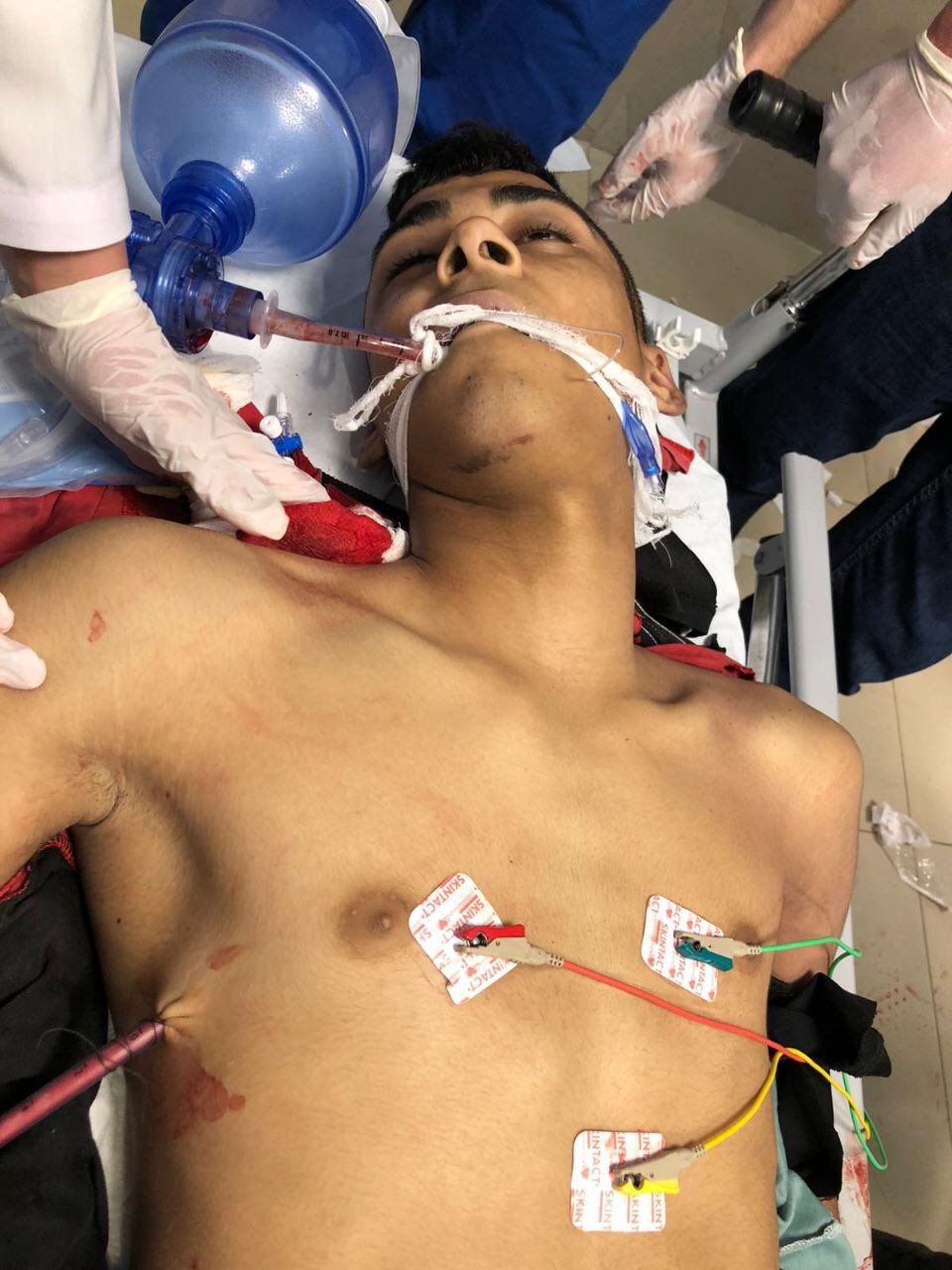 شهيدان و9 إصابات باشتباكات مسلحة مع قوات الاحتلال في جنين