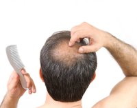 لماذا تقتل كورونا الرجال الصلع؟