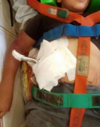 صور لا تصدق.. استخراج إطار قيادة دراجة من بطن طفل بمصر