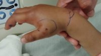 عجلون: طفلة بحالة حرجة إثر تعرضها للدغة من أفعى فلسطين
