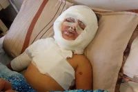 مأساة الطفلة مسك في غزة: حروق تحرمها من السمع والنطق وعائلتها تناشد للعلاج