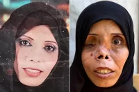 حين يهرب الاطفال من حضن الام.. مأساة وجه غزي شوهته الحرب